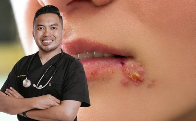 ‘Herpes Bukan Semata Datang Dari Pasangan’ – Dr. Samhan