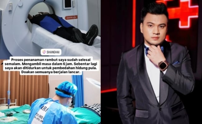 Iqbal Zulkefli Jalani Proses Tanam Rambut & Pembedahan Hidung Di Shanghai