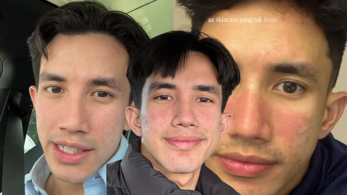 [VIDEO] Imran Aqil Didiagnos Sakit Kulit Rosacea, Kurangkan Aktiviti Sukan & Terdedah Cuaca Panas – ‘Penyakit Ini Tiada Ubat’