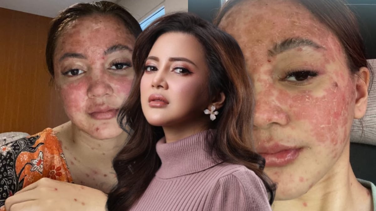 Sharmaine Alexander Nafi Buat Suntikan Filler, Dedah Hidap Penyakit Kulit – ‘Berhenti Buat Andaian & Pilih Untuk Buat Baik’