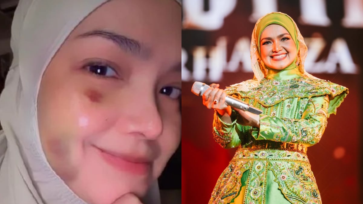 [VIDEO] Siti Nurhaliza Kongsi Pipi Lebam Sudah Beransur Pulih – ‘Lebam Biru Ambil Masa Nak Hilang’